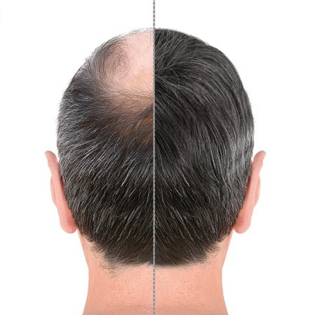 زراعة الشعر | Hair Transplantation